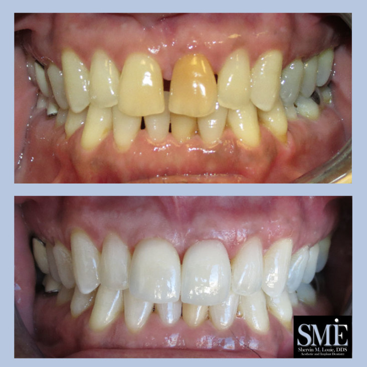 Veneer and Teeth Bleaching Results Shervin M. Louie, DDS