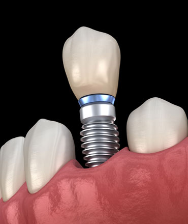 Dental Implants