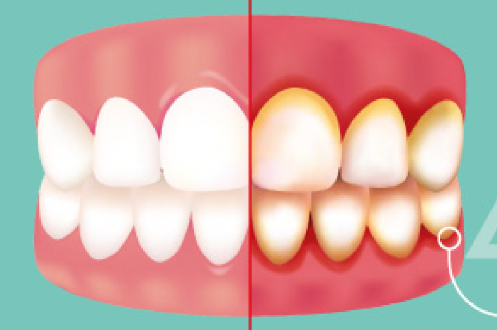 Symptoms and Treatment of Gingivitis Shervin M. Louie, DDS
